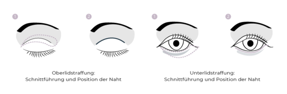 Grafik Augenlidstraffung, Schönheitschirurgie in Hamburg, Dr. med. Alaleh Jamshidi