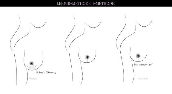 Grafik Brustverkleinerung Lejour (I-Methode), Schönheitschirurgie in Hamburg, Dr. med. Alaleh Jamshidi