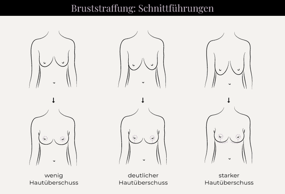 Grafik Bruststraffung Schnittführung, Schönheitschirurgie in Hamburg, Dr. med. Alaleh Jamshidi