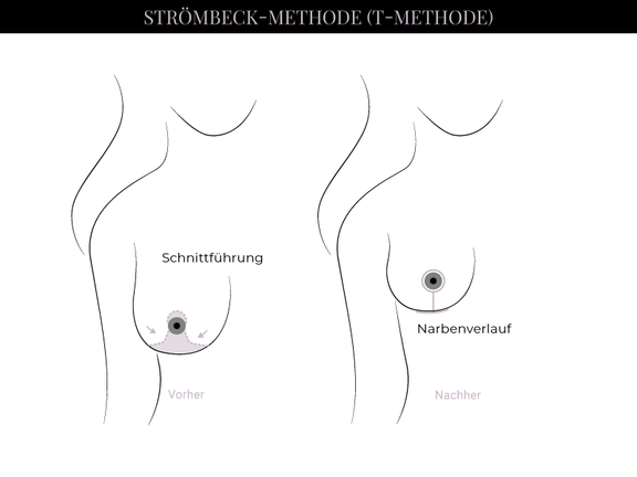 Grafik Brustverkleinerung T-Methode, Schönheitschirurgie in Hamburg, Dr. med. Alaleh Jamshidi