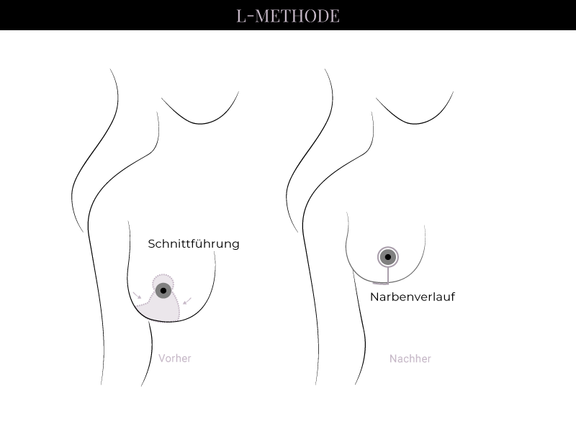 Grafik Brustverkleinerung L-Methode, Schönheitschirurgie in Hamburg, Dr. med. Alaleh Jamshidi