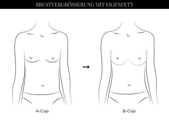 Grafik Brustvergrößerung Eigenfett, Schönheitschirurgie in Hamburg, Dr. med. Alaleh Jamshidi