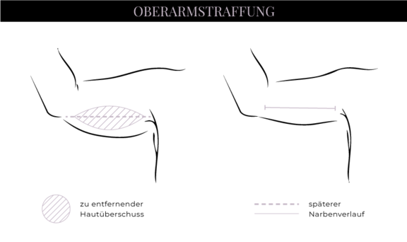 Grafik Oberarmstraffung, Schönheitschirurgie in Hamburg, Dr. med. Alaleh Jamshidi
