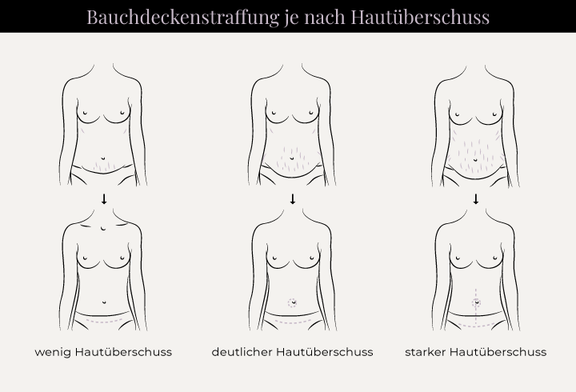 Grafik Bauchdeckenstraffung, Schönheitschirurgie in Hamburg, Dr. med. Alaleh Jamshidi