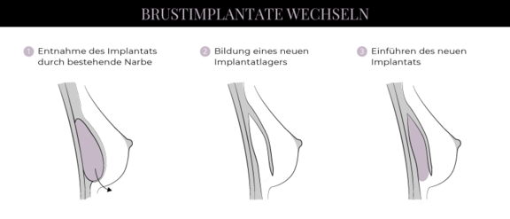 Grafik Brustimplantatwechsel, Schönheitschirurgie in Hamburg, Dr. med. Alaleh Jamshidi